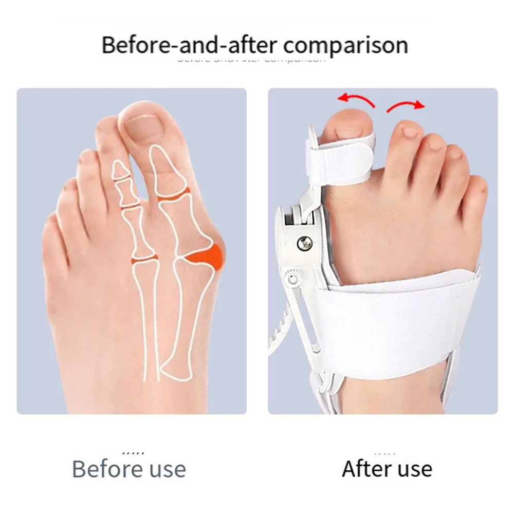 Bunion Straightener Toe Corrector Big Toe Eversion Splint Adjustable Hallux Valgus Corrector Foot Care Pain Relief Tools